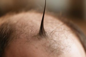 Активация анагена: ускоряю рост волос