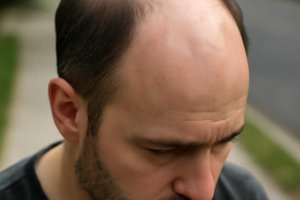 Простой тест покажет, должна ли вас беспокоить сезонная потеря волос