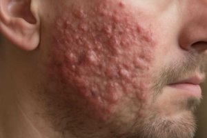 Фолликулярный муциноз кожи головы симптомы диагностика и лечение
