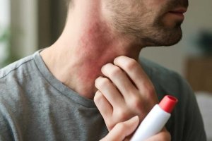 Аллергия на бензилникотинат в разогревающих лосьонах для кожи головы