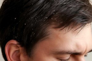 Перхоть после кератинового выпрямления и грамотный уход за кожей головы