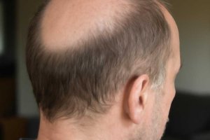Hair scalp после окрашивания у кромки волос