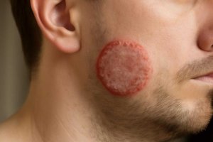 Трихофития кожи головы у взрослых ранние признаки и лечение