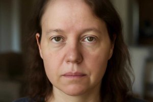 Анизотрихоз ресничного края и истончение волос у висков