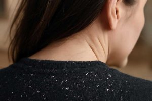 Как изгнать перхоть домашними методами: взгляд дерматокосметолога