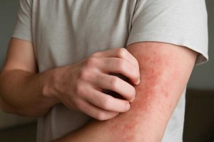Аллергический дерматит кожи головы после ароматизированных масел