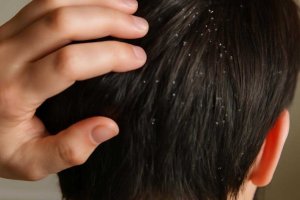 Домашние маски от перхоти без вреда для кожи головы