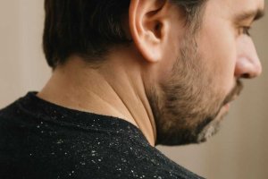 Перхоть: от микробиоты до ухода