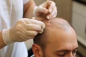 Микропересадка фолликулов: архитектура шевелюры