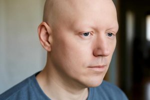 Алопеция после covid-19 и путь к восстановлению волос