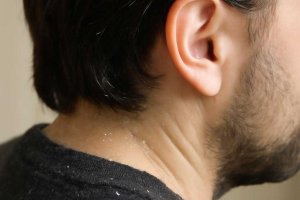 Три домашних шага против перхоти без лишнего ухода
