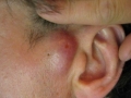 Атерома на лице (фото 2)