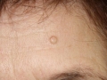 Атерома на лице (фото 4)