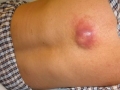 Атерома на спине (фото 4)
