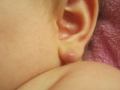 Атерома за ухом (фото 3)