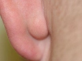 Атерома за ухом (фото 4)