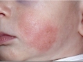 Атопический дерматит у детей (фото 2)