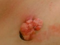 Папилломы на интимных местах (фото №2)
