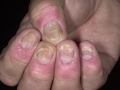 Псориаз ногтей