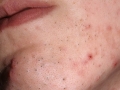 Сыпь на лице (фото №2)
