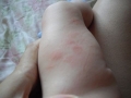 Сыпь на ногах у ребенка (фото №2)